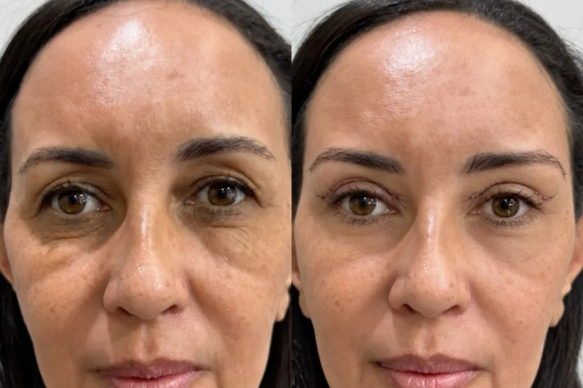 Antes e depois de blefaroplastia feita na Sorriclin
