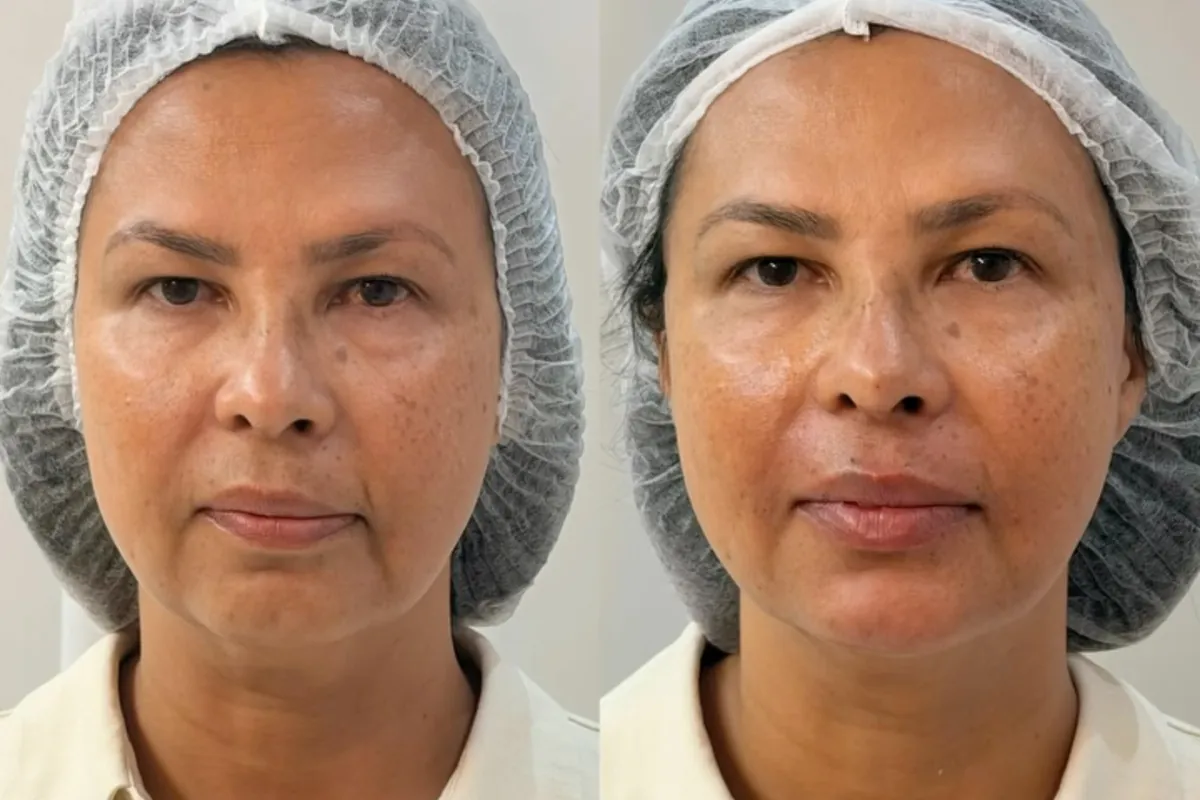 Antes e depois de reestruturação facial feita na Sorriclin