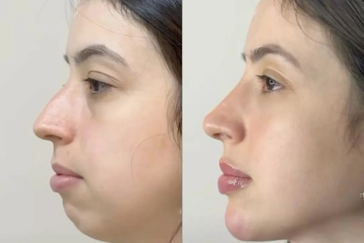 Antes e depois de perfil de paciente da Sorriclin, com nariz e queixo mais harmônicos